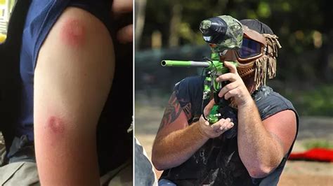 How to Treat & Prevent Paintball Bruises and Welts 2024