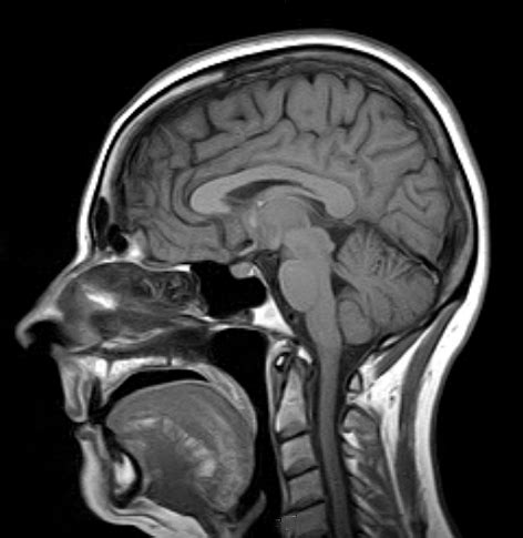 Brain MRI scan | Medserena Open MRI