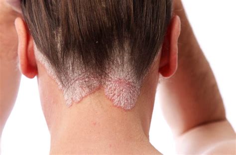 Plaque psoriasis scalp pictures | Symptoms and pictures