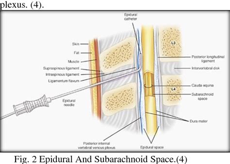 Table 4 from SINGLE -DOSE INTRATHECAL ANALGESIA TO CONTROL LABOR PAIN IS A USEFUL ALTERNATIVE TO ...