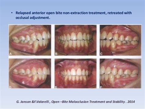 Anterior open bite treatment permanent dentition -1- .slide