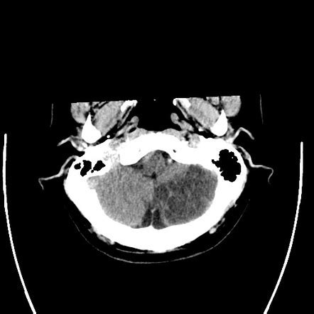 Left cerebellar infarct: PICA vascular territory | Radiology Case ...