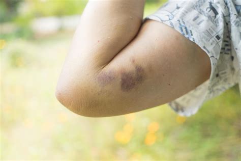 What is a contusion (bruise)? Bones, muscles, and more