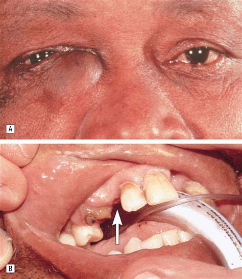 Eye-Tooth: A Case of Orbital Dentigerous Cyst After Trauma | JAMA Ophthalmology | JAMA Network