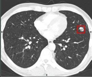 Lung Cancer Screening CT - San Diego Imaging Radiology