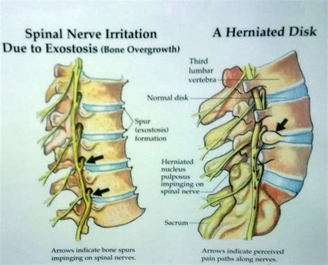 Overcoming HNP