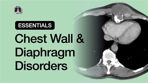 Chest Wall & Diaphragm Disorders | Chest Radiology Essentials - YouTube