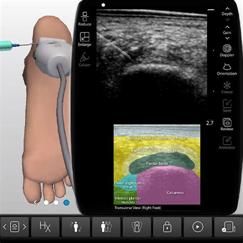 Plantar Fascia Ultrasound-Guided Injections Procedure Module