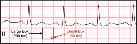 Estimating heart rate from ekg strip – Telegraph