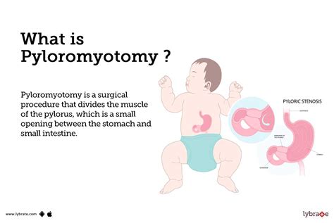 Pyloromyotomy: Causes, Symptoms, Treatment and Cost