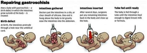 Gastroschisis - What is?, Causes, Pictures, Repair, Treatment