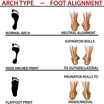 Symptoms and treatment for high and painful arches