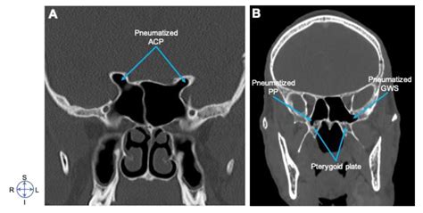 Sphenoid Sinus Anatomy