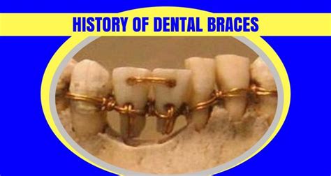 A Peek into the History of Braces - Expert Dental Care