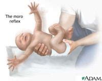 Neonatal reflexes and how they continue to effect us if they are retained. | Moro reflex ...