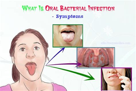 What Is Oral Bacterial Infection? - Causes, Symptoms, Prevention