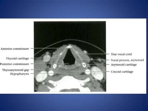 Larynx anatomy and laryngeal ca