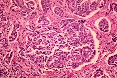 Lung Cancer Cells vs Normal Cells — Pictures and Behavior ...