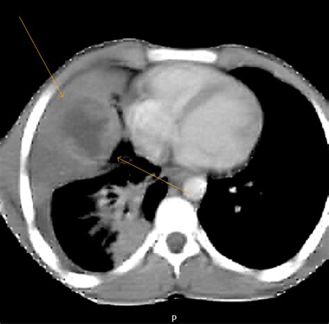 Hydatid Cyst-CT - Sumer's Radiology Blog