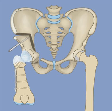 SUPERhip - Paley Orthopedic & Spine Institute