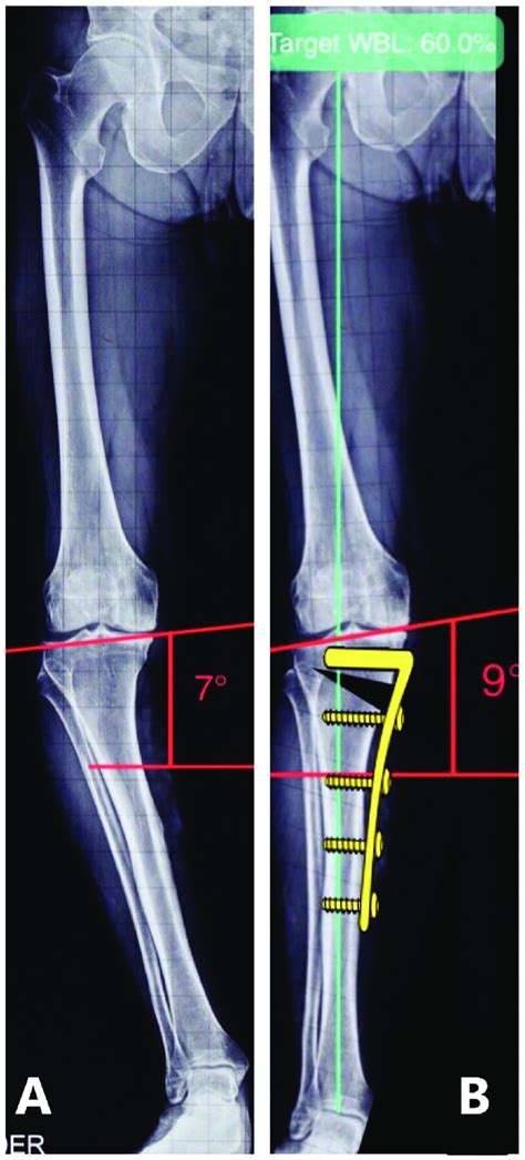 Severe genu varum and implications of the traditional onelevel ...