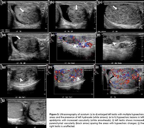 Figure 3 from Tuberculous Epididymo-orchitis Demonstrating a Sonographic Miliary Pattern ...