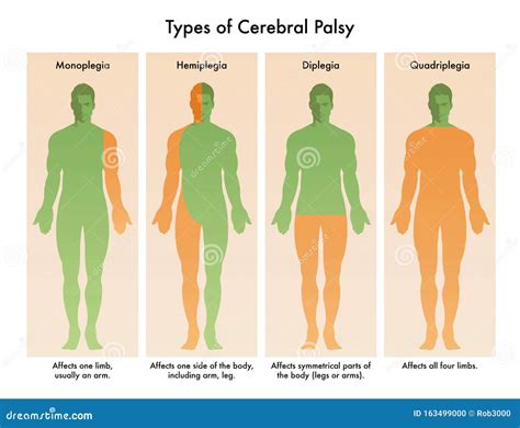 Cerebral Palsy Medical Illustration | CartoonDealer.com #163499000