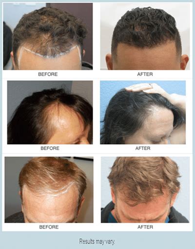 Hair Transplant Surgery: What to Expect - Prasad, Nalini (sacramentohairdoctor.com)