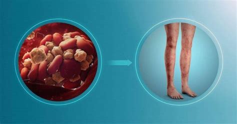 Antiphospholipid Syndrome: 14 Symptoms, Risk Factors, Causes, Diagnosis, And Complications