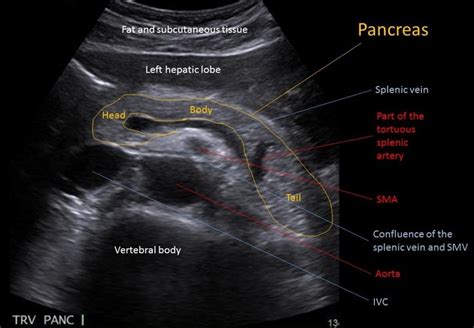 Splenic Vein Ultrasound