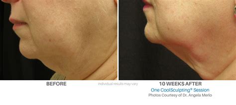 CoolSculpting Before and after - CoolSculpting New Jersey