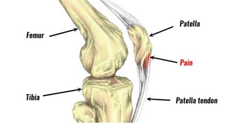 Knee Pain From Running - Top Five Causes & Treatment