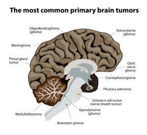 Brain Tumor Types & Symptoms - Dr. Etame