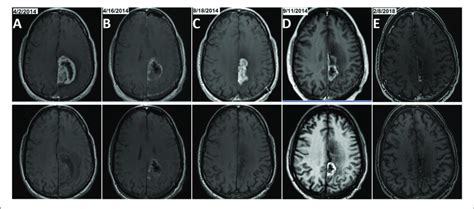 | Example of MRI results from patient number 3, a long-term survivor in... | Download Scientific ...