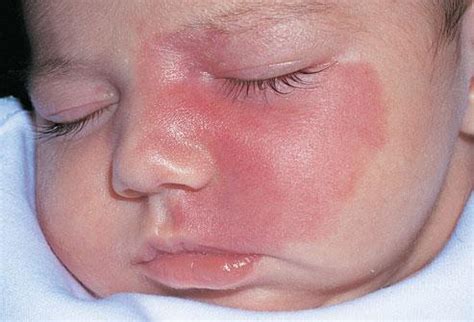 What causes strawberry birthmarks? – What causes this?