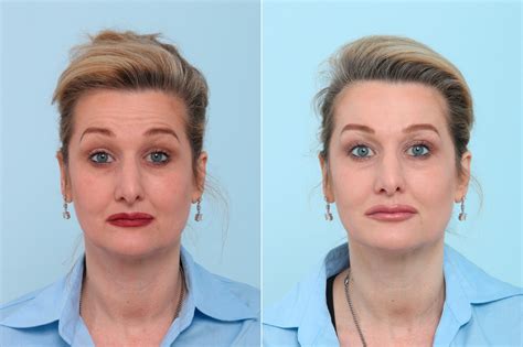 Botox® Cosmetic Photos | Houston, Tx | Patient 7770