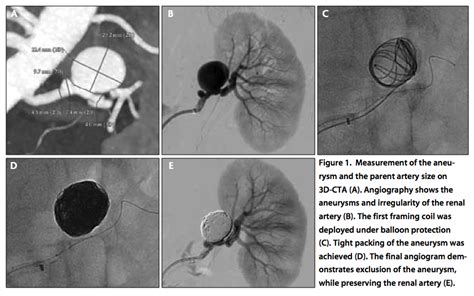 Endovascular Today - Packing Density Considerations for True Visceral Aneurysms (August 2014)