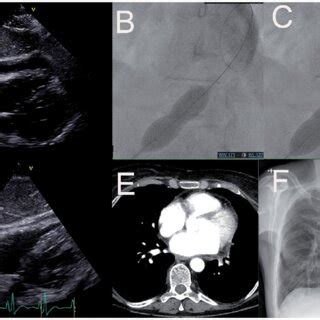 (PDF) Percutaneous balloon pericardiotomy: efficacy in a series of malignant and nonmalignant cases