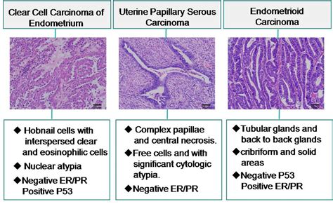 Frontiers | Clear Cell Carcinoma of the Endometrium: Evaluation of ...