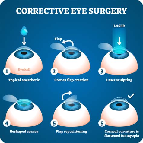 Laser Eye Surgery