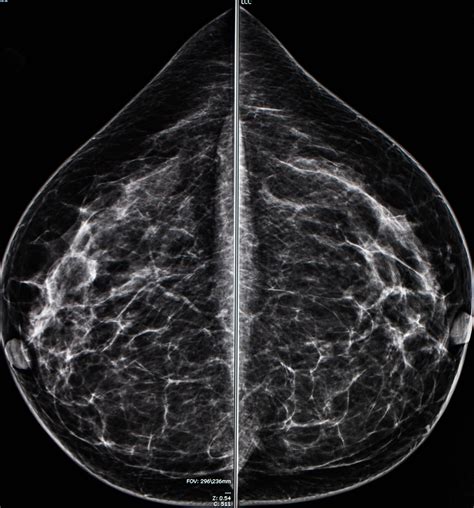 Mammogram radio imaging for breast cancer diagnosis - ODC