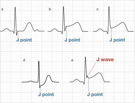 J point ECG Interval • LITFL • ECG Library Basics