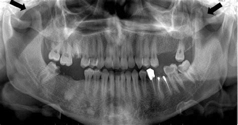 Coronoid Process Radiograph