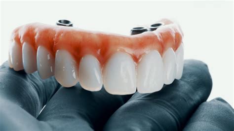 Hybrid Prosthesis: Frequently Asked Questions - Dental Excellence ...