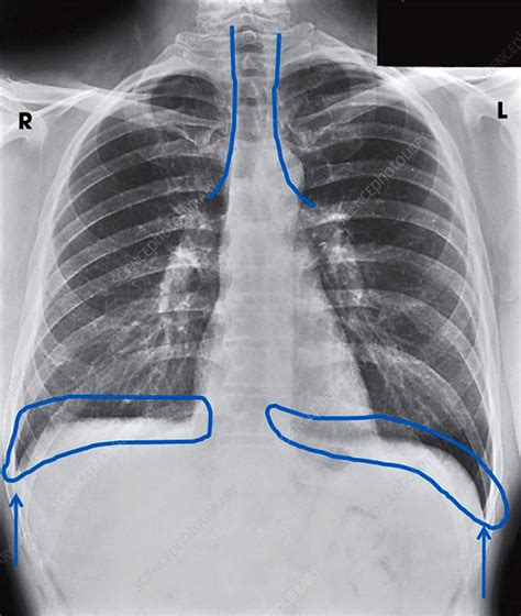 Chest X-Ray Showing Costophrenic Angles - Stock Image - C042/9927 - Science Photo Library