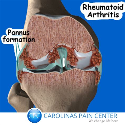 Rheumatoid Arthritis Knee Pain - Carolinas Pain Center