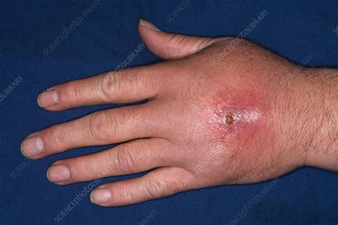 MRSA Hand Infection - Stock Image - C007/5586 - Science Photo Library