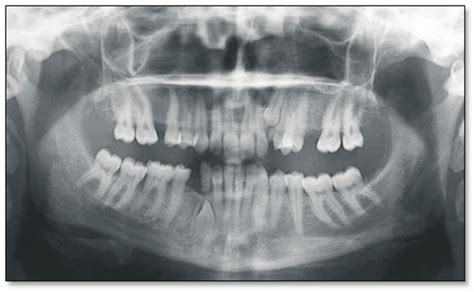 A vertically impacted mandibular canine tooth and primary canine ...