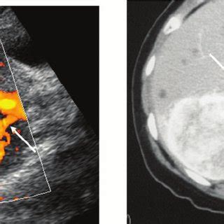 49-year-old woman with a histology-proven hepatic angiomyolipoma. (a ...