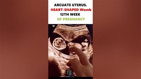 ARCUATE UTERUS. HEART-SHAPED Womb 12TH WEEK OF PREGNANCY #pregnancy # ...